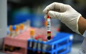 Exame de sangue detecta até 86% de casos de câncer de ovário precocemente