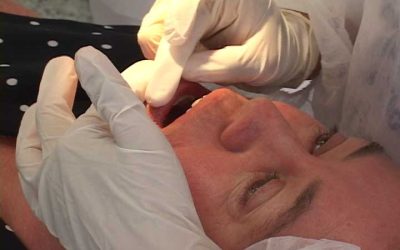Aumentam casos de câncer oral entre 30 e 44 anos