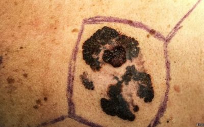 Como reconhecer os sinais de câncer de pele