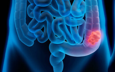 Março Azul-Marinho: mês de conscientização sobre o câncer colorretal